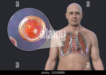 Illustrazione di un uomo con adiaspiromicosi polmonare, un'infezione respiratoria causata dal fungo Emmonsia spp., caratterizzata dalla presenza di spore fungine incapsulate ingrandite all'interno dei tessuti polmonari. Foto Stock