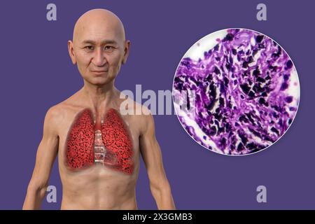 Illustrazione di un uomo con i polmoni del fumatore, insieme a un'immagine micrografica dei polmoni colpiti dal fumo. Foto Stock