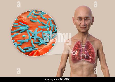 Illustrazione di un uomo con polmoni affetti da tubercolosi cavernosa e vista ravvicinata dei batteri Mycobacterium tuberculosis. Foto Stock