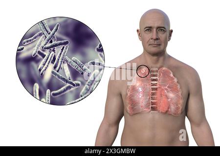 Illustrazione di un uomo con polmoni affetti da tubercolosi secondaria e vista ravvicinata dei batteri Mycobacterium tuberculosis. Foto Stock