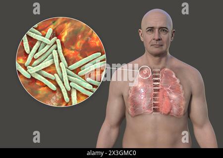 Illustrazione di un uomo con polmoni affetti da tubercolosi secondaria e vista ravvicinata dei batteri Mycobacterium tuberculosis. Foto Stock