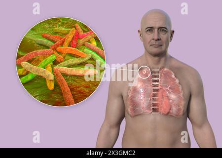 Illustrazione di un uomo con polmoni affetti da tubercolosi secondaria e vista ravvicinata dei batteri Mycobacterium tuberculosis. Foto Stock