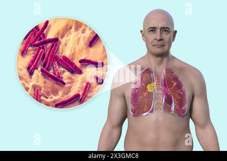 Illustrazione di un uomo con tubercolosi polmonare primaria, che rivela il complesso Ghon e la linfoadenite mediastinica e una vista ravvicinata dei batteri Mycobacterium tuberculosis. Foto Stock