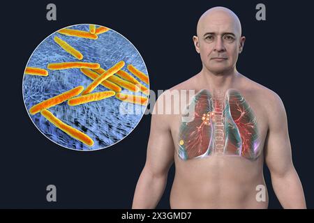 Illustrazione di un uomo con tubercolosi polmonare primaria, che rivela il complesso di Ranke, evidenzia lesioni polmonari e linfoadenite mediastinica, insieme a una vista ravvicinata dei batteri Mycobacterium tuberculosis. Foto Stock