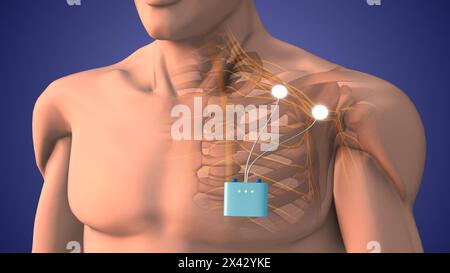 Terapia di stimolazione dei nervi periferici nell'area della spalla Foto Stock