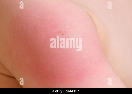 Gonfiore e rossore sulla spalla del bambino dopo la vaccinazione. Effetto collaterale del vaccino in un bambino Foto Stock