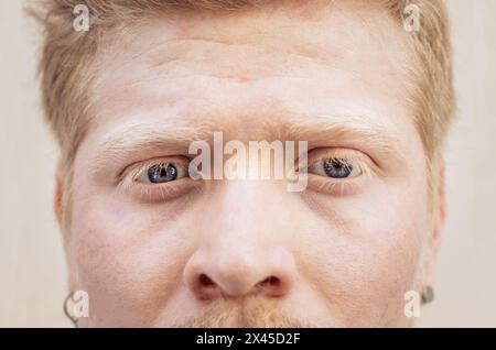 Primo piano ritratto delle caratteristiche facciali di un uomo albino latino. Le sue lunghe ciglia bianche proteggono i suoi occhi blu dalla luce del sole. Foto Stock
