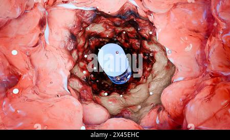 Probiotici nel tratto intestinale. endoscopia attraverso l'intestino. Microbiota, Capsula per pillole con vitamine per l'apparato digerente, trattamento del dolore allo stomaco, Rosso Foto Stock