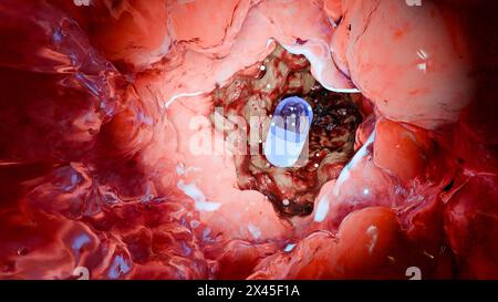 Probiotici nel tratto intestinale. endoscopia attraverso l'intestino. Microbiota, Capsula per pillole con vitamine per l'apparato digerente, trattamento del dolore allo stomaco, Rosso Foto Stock