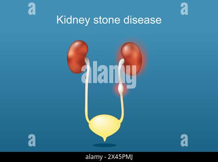 Malattia da calcoli renali. Anatomia del sistema urinario umano. Reni, uretere con pietra, vescica urinaria e uretra. Calcoli renali. Poster vettoriale. Isometrico Illustrazione Vettoriale