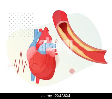 Stadi di aterosclerosi - accumulo di placca di colesterolo nel cuore - illustrazione delle scorte come file EPS 10 Illustrazione Vettoriale