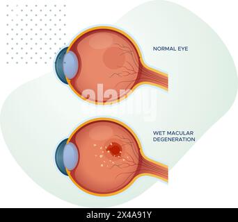 Occhi sani vs degenerazione maculare bagnato - illustrazione di scorta come file EPS 10 Illustrazione Vettoriale