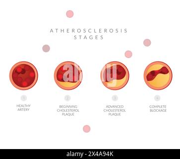 Stadi di aterosclerosi - accumulo di placca di colesterolo - illustrazione delle scorte come file EPS 10 Illustrazione Vettoriale