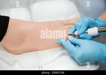 Una sessione di pedicure medica coinvolge un podiatra che tratta l'unghia del piede utilizzando una fresatrice. Foto Stock