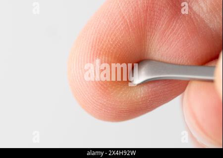 Pelle danneggiata al dito con vista ravvicinata della vescica macro Foto Stock