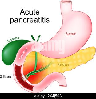 Pancreatite acuta. Infiammazione del pancreas. Immagine realistica degli organi addominali cistifellea, duodeno, stomaco e pancreas. Primo piano di un gallstone t Illustrazione Vettoriale