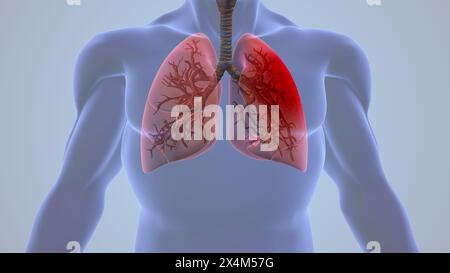 Pleurite umana infiammazione polmonare dolore Foto Stock
