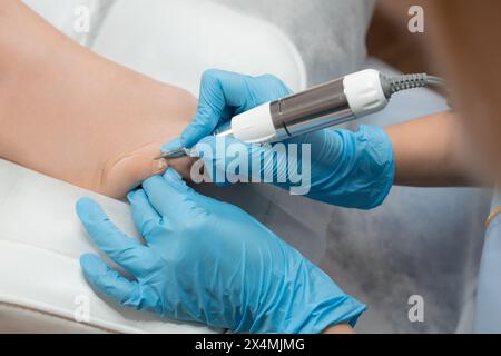 Durante una pedicure medica, un podiatra impiega una fresatrice per trattare l'unghia del piede Foto Stock