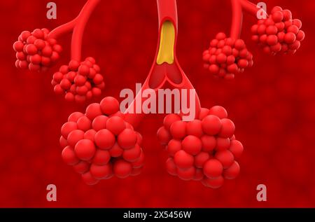 Fibrosi cistica (CF) - Vista isometrica illustrazione 3d. Foto Stock