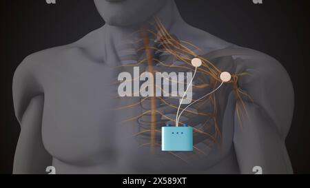 Terapia con stimolazione dei nervi periferici nella regione della spalla Foto Stock