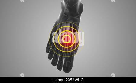 Fastidio al tendine extensor digitorum longus che innesca il dolore Foto Stock