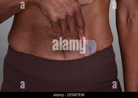 Pancia di donna matura con cerotto alla nicotina Foto Stock