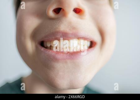 bambino di 12 anni mostra oscillazioni e ferite dei denti, nozione odontoiatria pediatrica, trattamento dentale e correzione dell'occlusione, igiene orale, trattamento della cro Foto Stock