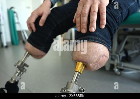 un uomo con protesi delle gambe impiantate nell'osso. osteointegrazione Foto Stock
