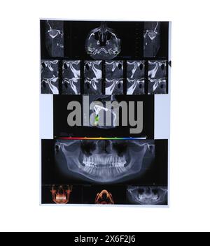 Scansioni radiografiche della sezione maxillo-facciale umana per analisi dentistiche isolate su bianco Foto Stock