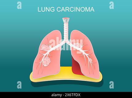 Carcinoma polmonare. Cancro ai polmoni. I tumori metastatizzano, diffondendosi ad altre parti del corpo. Poster vettoriale. Illustrazione piatta isometrica. Illustrazione Vettoriale