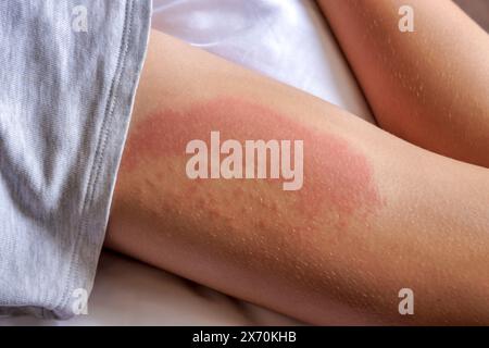 Eruzione cutanea sulla gamba di un bambino Foto Stock