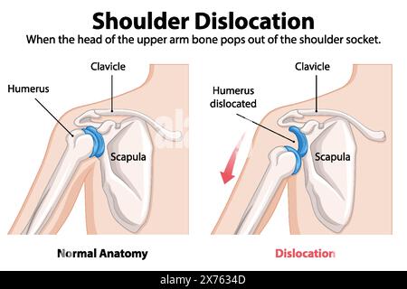 Confronto dell'anatomia spalla normale e dislocata Illustrazione Vettoriale