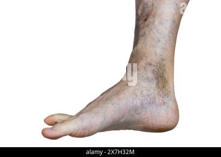 Questa immagine rivela una gamba afflitta da vene varicose pronunciate, indicando potenziali problemi del sistema circolatorio. Foto Stock