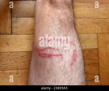 Una puntura di meduse brucia sulla gamba di un uomo Foto Stock