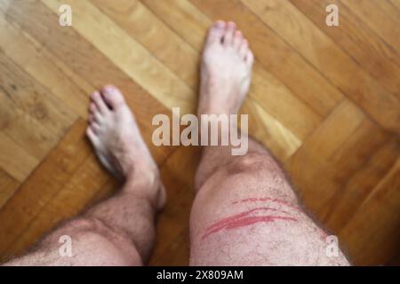 Una puntura di meduse brucia sulla gamba di un uomo Foto Stock