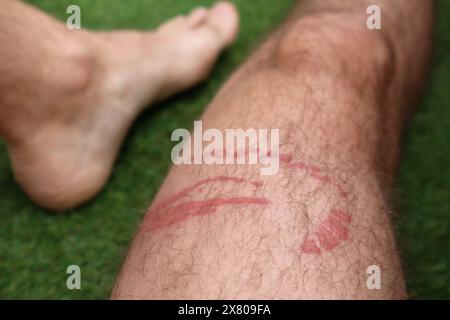 Una puntura di meduse brucia sulla gamba di un uomo Foto Stock