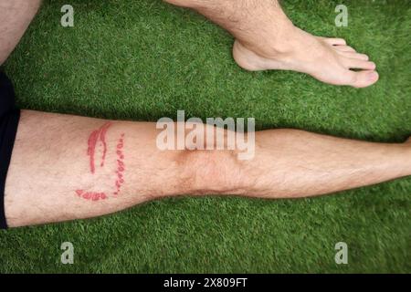 Una puntura di meduse brucia sulla gamba di un uomo Foto Stock