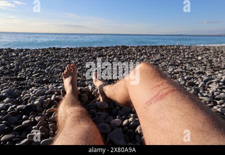 Una puntura di meduse brucia sulla gamba di un uomo Foto Stock