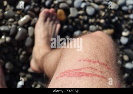 Una puntura di meduse brucia sulla gamba di un uomo Foto Stock