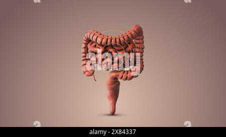 Animazione medica della sindrome dell'intestino irritabile Foto Stock