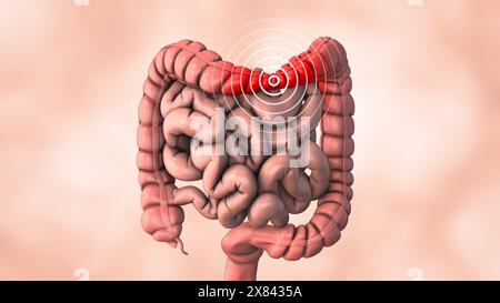 Mal di stomaco causato da una condizione intestinale Foto Stock