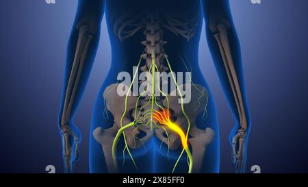 Dolore al nervo sciatico nella parte inferiore della schiena attraverso i fianchi fino alla gamba Foto Stock