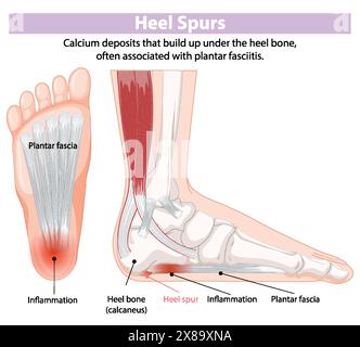 Illustrazione di speroni e infiammazione del tallone Illustrazione Vettoriale