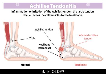 Confronto tra tendine d'Achille normale e tendine d'Achille infiammato Illustrazione Vettoriale