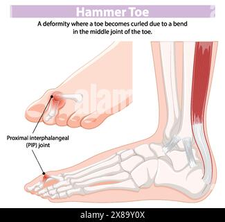 Schema che mostra la deformità della punta del martello e il giunto PIP Illustrazione Vettoriale