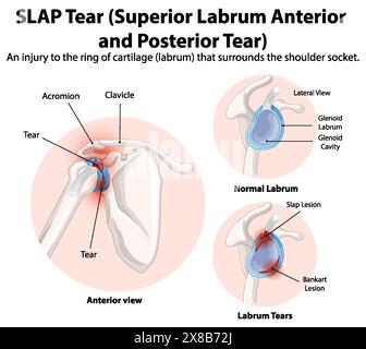 Diagramma dettagliato della lacerazione della spalla nell'articolazione della spalla Illustrazione Vettoriale