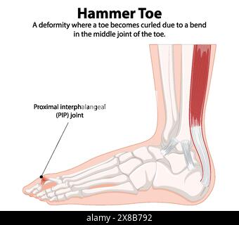 Schema che mostra la deformità della punta del martello e il giunto PIP Illustrazione Vettoriale