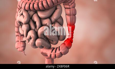 Un disturbo intestinale che causa dolore allo stomaco Foto Stock