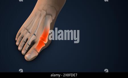 Hallux Valgus Correction Bunion Surgery in Foot Foto Stock