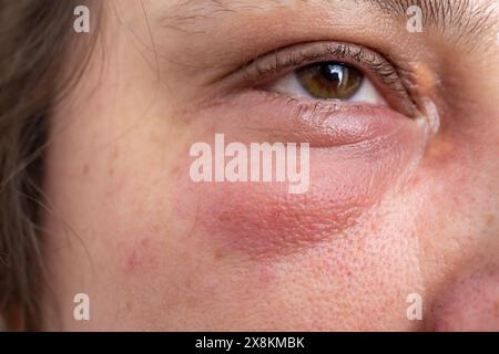 Occhio di Swallen, calazion esterno o Hordeolum , sulla palpebra di una donna caucasica Foto Stock